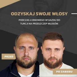 Przeszczep Włosów w Turcji - Skorzystaj z analizy online.